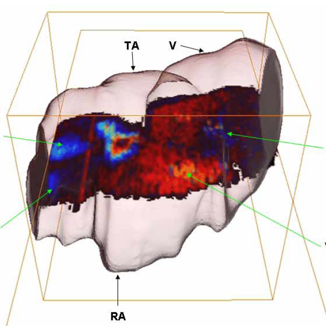 3D Doppler of embryo heart