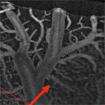 Speckle variance detection of microvasculature using swept-source optical coherence tomography