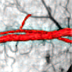 3D OCT image of blood vessel